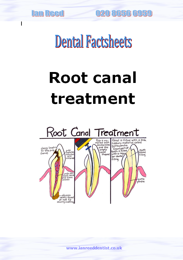 Root canal treatment factsheet